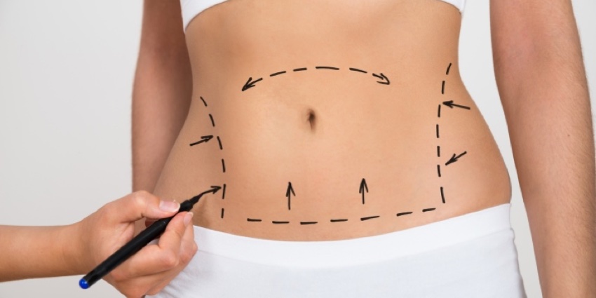 Abdominoplastie Tunisie - Lifting du ventre
