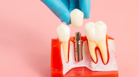 Pose d'implant dentaire
