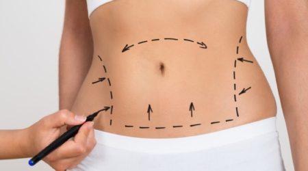 Abdominoplastie Tunisie - Lifting du ventre